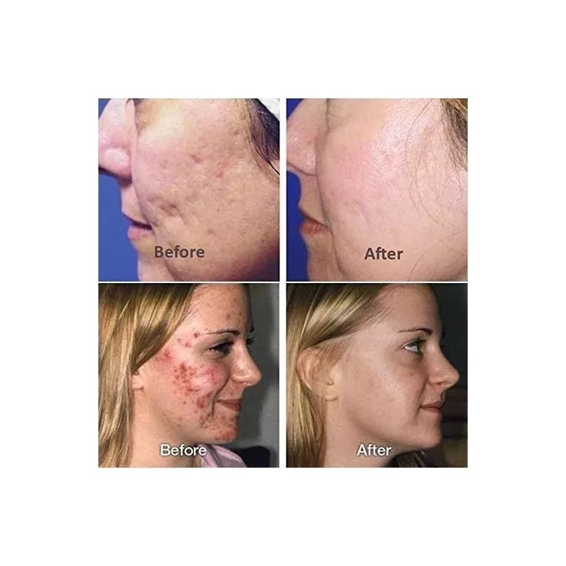 Universo en Linea Acido Hialuronico Facial, Antiedad, Manchas, Acne 5pzs