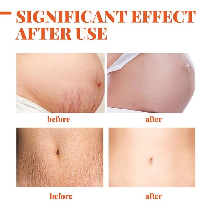 INTIMIFY Stretch Mark Removal Cream For Women, Stretch Mark Cream