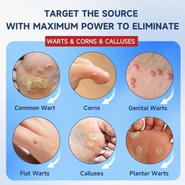 NewX Fast Action Wart Gel Maximum Strength - Wart with Salicylic Acid - Fast-Acting Wart Freeze Off Designed for Warts, Plantar Wart, Genital Wart, Common Wart, Flat Wart, Corn, Callus-G-03