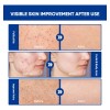 Crema Para El Tratamiento De La Foliculitis Y El Acné