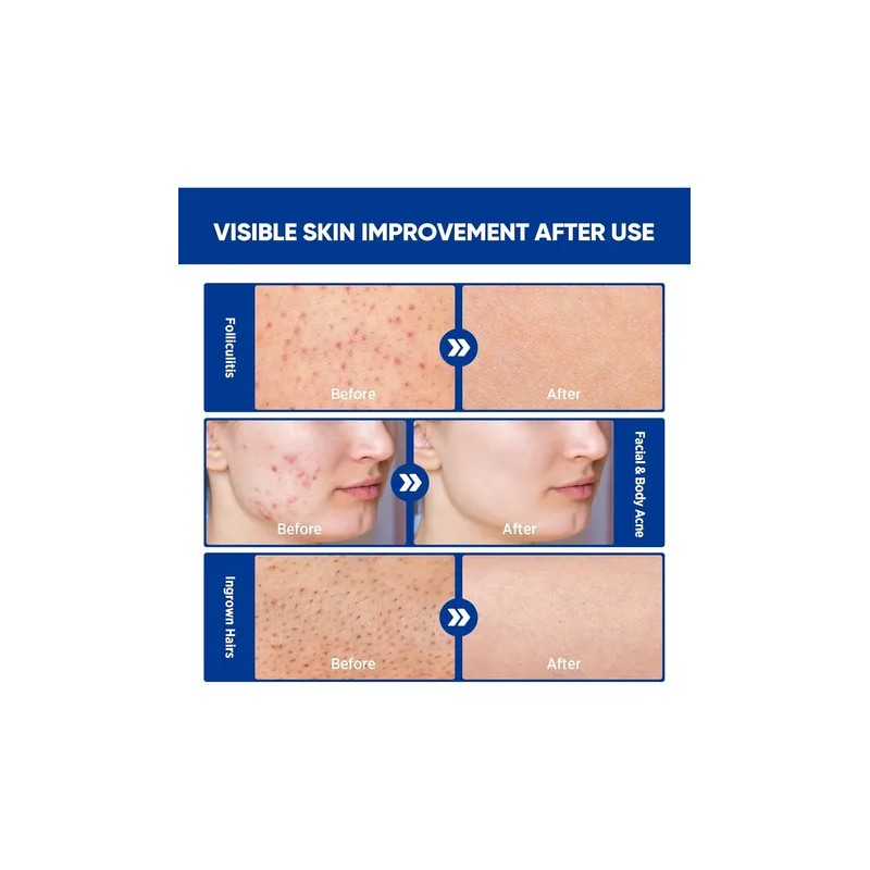 Crema Para El Tratamiento De La Foliculitis Y El Acné
