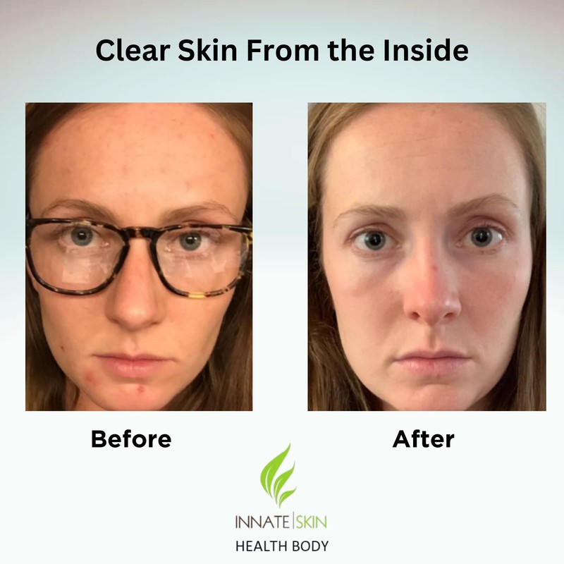 Clear Skin Acne Vitamin System | 20 Antioxidants, Botanicals &