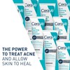 CeraVe Acne Foaming Cream Cleanser, 4% Benzoyl Peroxide Face Wash