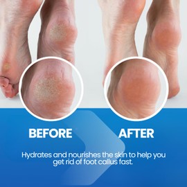 Callus Remover for Feet Extra Strength with Stainless Steel Foot File (Pedicure Grade) - Professional Foot Rasp Callus Remover Softener - Callus Treatment Heels, and Hands - Cuticle Remover & Softener