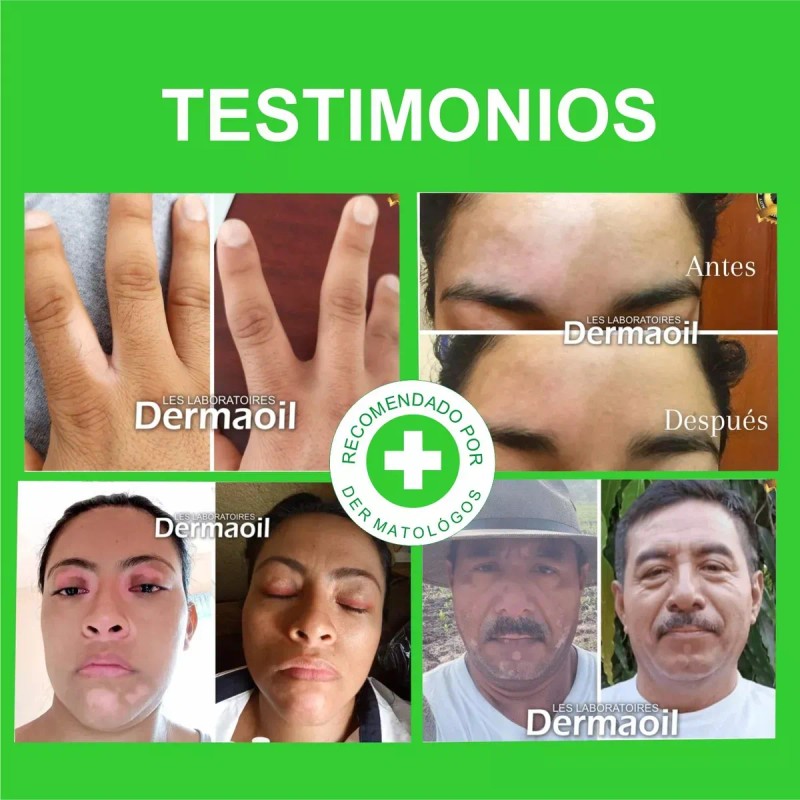 Kit Natural Con Melagenina Para El Tratamiento Del Vitiligo