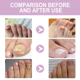 Nail Growth Serum,Cuticle Oil for Nail,Nail Strengthener for Damaged Nails,Nail Growth Treatment,Rejuvenation Nail Growth Oil,Nail Nutrition Pen for Moisturize Dry Nails & Cuticles Care,Nail Care