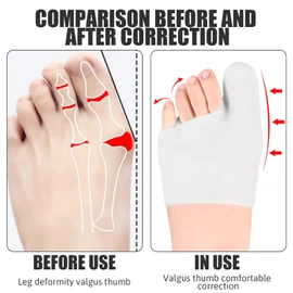 2 Pack Gel Big Toe Cap & Metatarsal Sleeves -Large White Bunion Cushions & Protectors for Men & Women - Relieve Bunion Pain,Prevent Corns,Calluses,Blisters & Ingrown Toenails - Comfortable & Reusable
