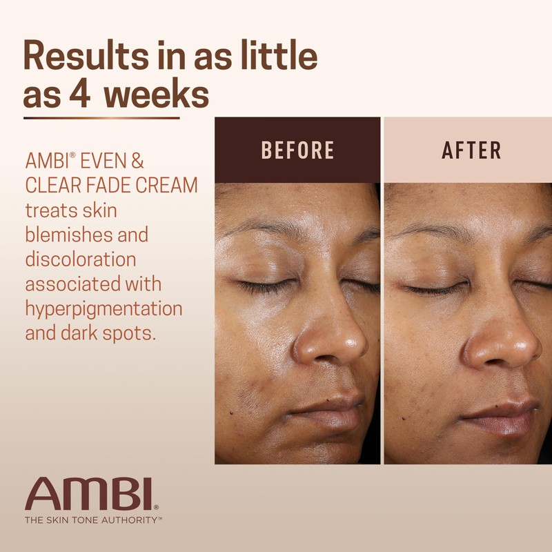 Ambi Even & Clear Fade Cream, Hydroquinone-free, Hyperpigmentation Treatment, Dark