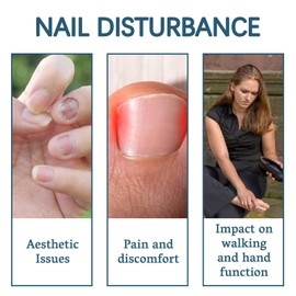 Nail Strengthening Solution 30ml with Cuticle Oil | Plant-Based Formula to Improves Brittleness & Discoloration, Nail Tending for Stronger, Healthier-Looking Nails