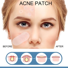 Große Pickel Patches in 5 Größen für große Pickel, 80 Patches Akne Pimple Patches für Gesicht und Körper zur Abdeckung von Pickeln, Hautunreinheiten und Akne, geeignet für alle Hauttypen