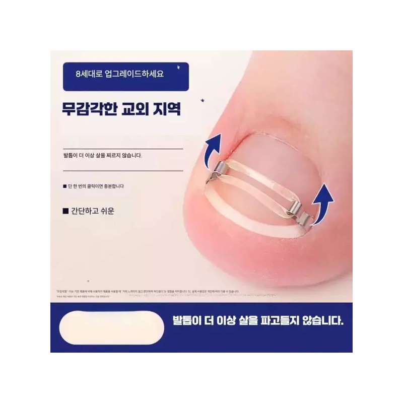 내성발톱교정기 발톱교정기 엄지발톱 내성손톱 [교정기 2개] Ingrown Toenail Correction Device,