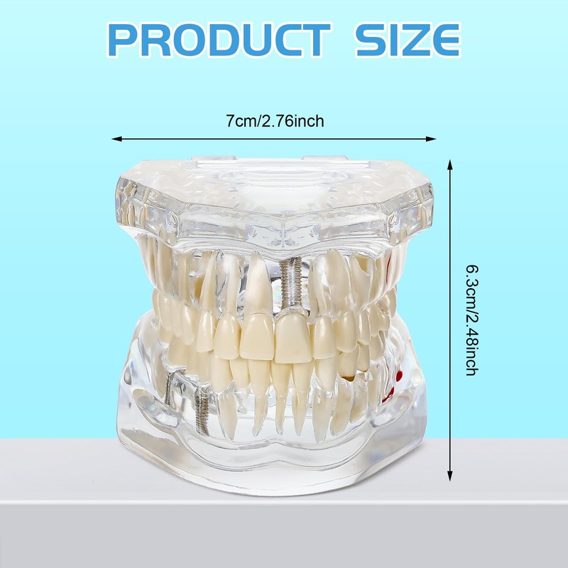 Outus Disease Teeth Model Dental Typodonts Implant Teeth Model with