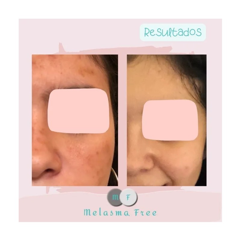 Crema Despigmentante Melasma Free 30ml Con Ácido Azelaico
