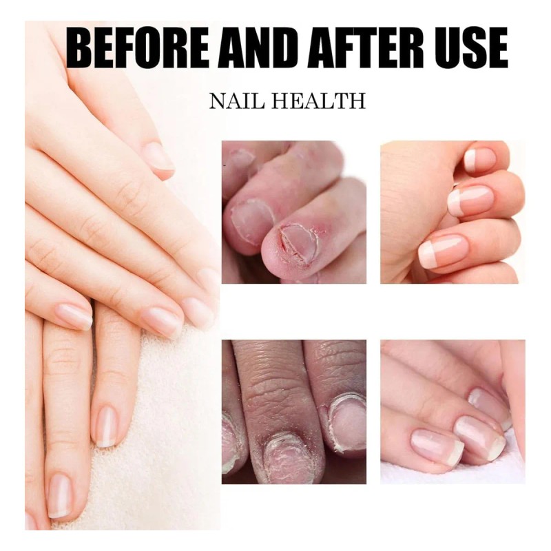 Gotas De Plantas Para El Cuidado De Las Uñas, Aceite