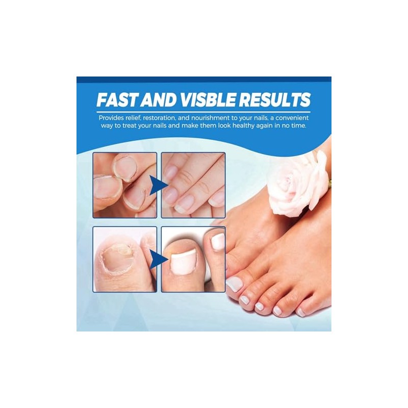 Ginger Nail Tratamiento Uñas Jengibre Soporte Cuidado Suero Crecimiento Aceite
