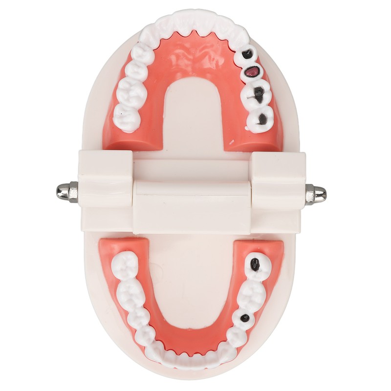 Dental Disease Caries Teeth Model Resin Simulation Teaching Prop Dental