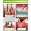 Toothpaste Gum Repair for Avoid Root Canal Therapy, Gingivitis Treatment