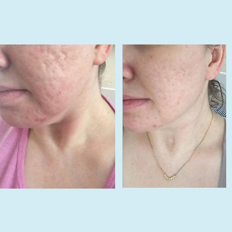 Glycolic Acid 50% Gel Peel - Enhanced with Retinol &