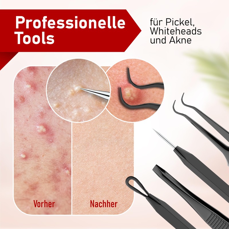 NEUMANN® Blackhead Remover Set (Stainless Steel) for Removing Pimples, Blackheads