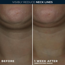 RoC Derm Correxion Neck Cream with Hyaluronic Acid and Advanced Retinol to visibly Tighten & Lift Horizontal Neck Lines, Facial Moisturiser to Contour Face, Neck and Jawline, 1.7oz