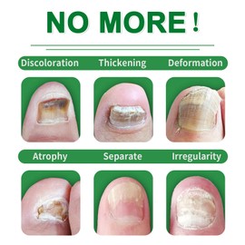 Ingwer-Nagelserum, Ingwer-Nagelpflege und Wachstumsserum, Ginger Nail Treatment Strengthener, Nagelwachstums- und Reparaturserum, Schutz & Stärkung Brüchiger Nägel (2pcs)