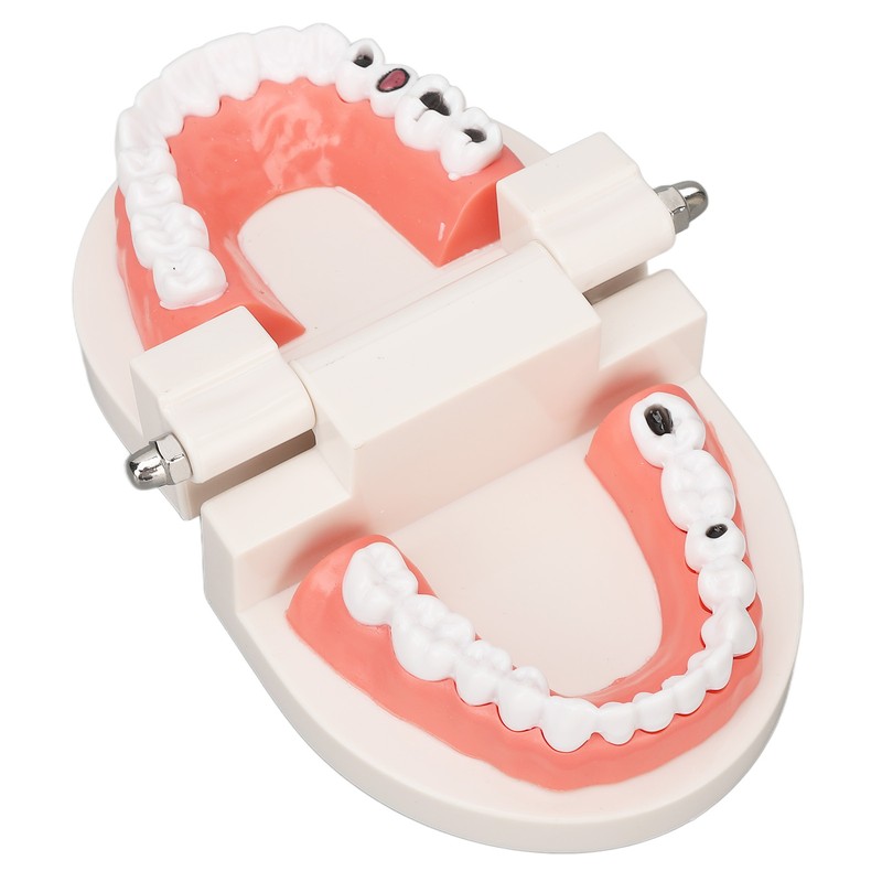 Dental Disease Caries Teeth Model Resin Simulation Teaching Prop Dental