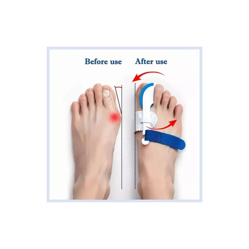Kit De Correctores De Juanete Y Protectores 11 Pzas Blanco