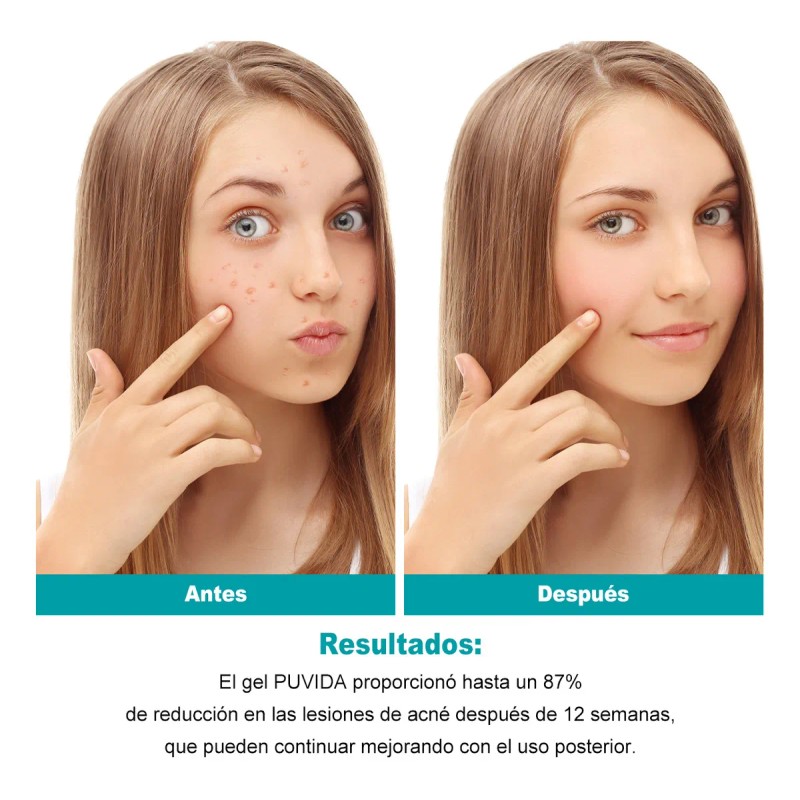 Gel Facial Anti-imperfecciones Tipo De Piel Acne