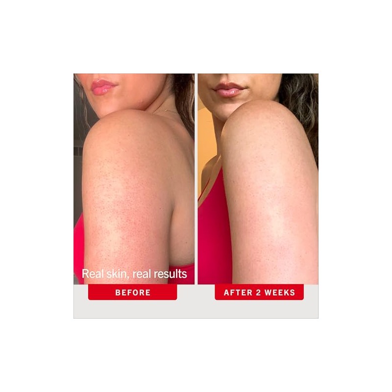 First Aid Beauty Exfoliante corporal KP Bump Eraser con 10%