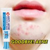 No Brand Real and effective Acne Pimple Cream 祛痘膏祛痘乳霜 20g