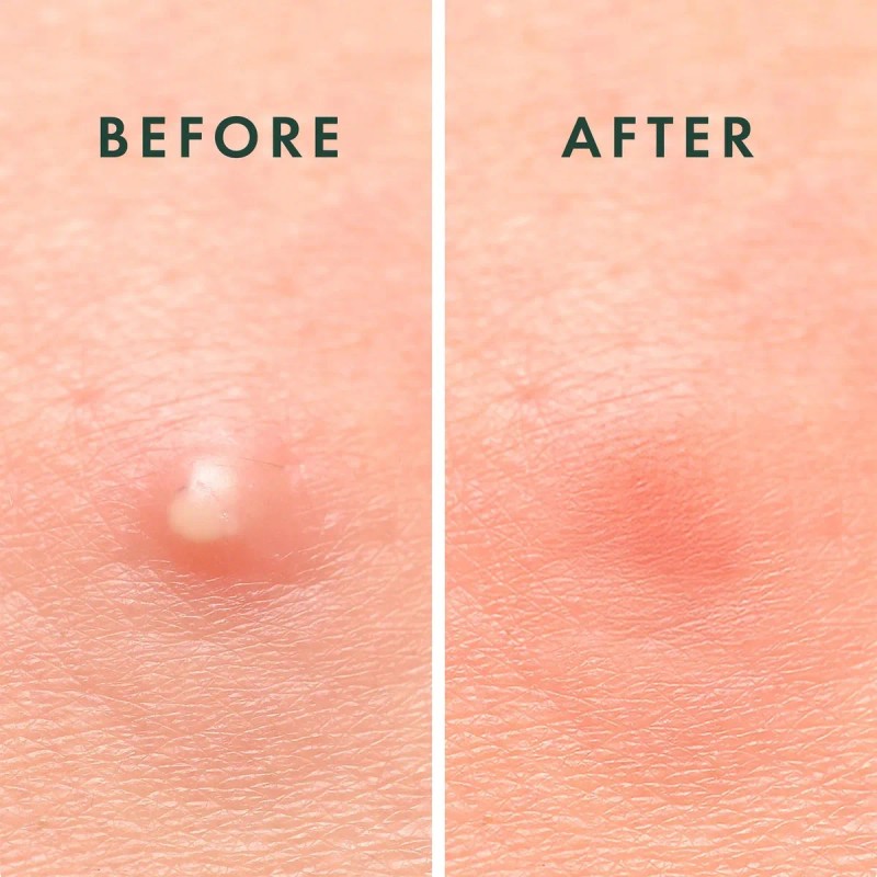 Rael Parche Hidrocoloide Rael Para Acné - 24 Piezas Makeup