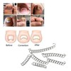Ingrown Toenail Treatment Kit Glue Free Pedicure Ingrown Toenail Corrective