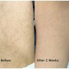 Keratosis Pilaris Body Wash – Targets Bumpy Skin, Strawberry Legs