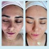 Salicylic Acid 20% Gel Peel - Enhanced with Tea Tree