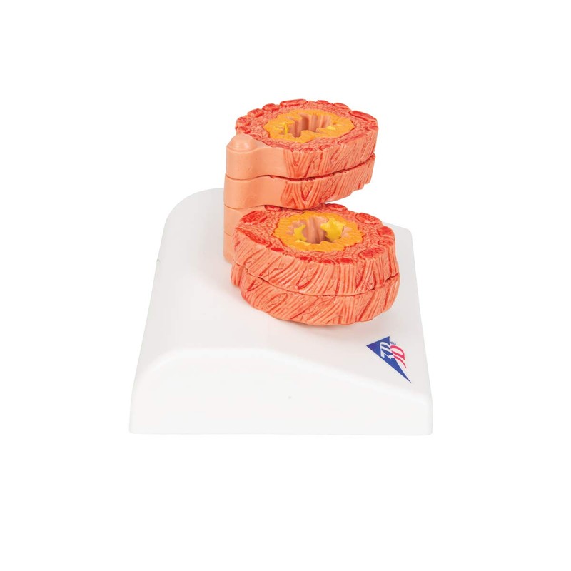 3B Scientific Human Anatomy - COPD Model + Free Anatomy