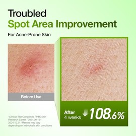 Anua Suero Facial de Ácido Azelaico 10% Hialurónico en Rojo Tranquilizante, Suero Facial para Piel Sensible y Problemática, Brotes, Ácido Hialurónico,