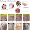 Ingrown Toenail Treatment Kit Glue Free Pedicure Ingrown Toenail Corrective