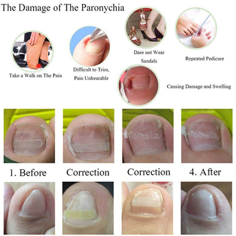 Ingrown Toenail Treatment Kit Glue Free Pedicure Ingrown Toenail Corrective