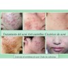 Experto En Eliminar Acne Y Sus Cicatrices