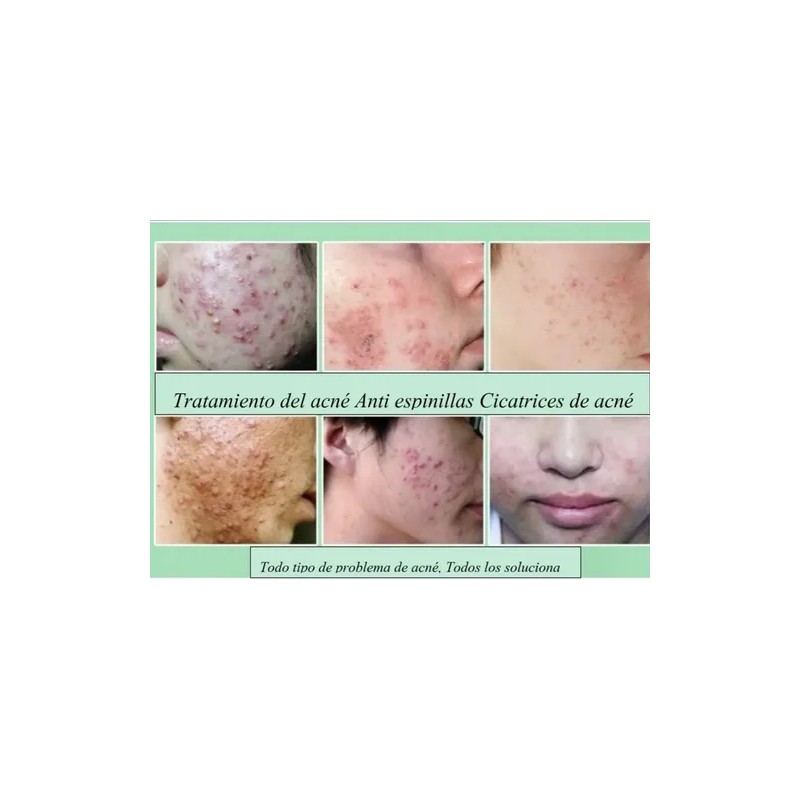 Experto En Eliminar Acne Y Sus Cicatrices