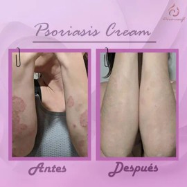 Psoriasis Cream, Facial Corporal Psoriasis Aliviante.