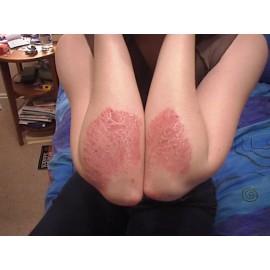 Homemade scaly skin salve