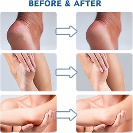 Urea Cream 60 Percent for Feet,Urea Foot & Hand Cream for Cracked Heels and Dry Skin,Cracked Heel Repair Cream,Foot Moisturizer,Maximum Strength,Skin Care Hands & Feet,Callus and Dead Skin Remover