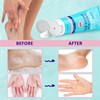 Urea Cream 42% - Foot Care for Dry Cracked Heels,