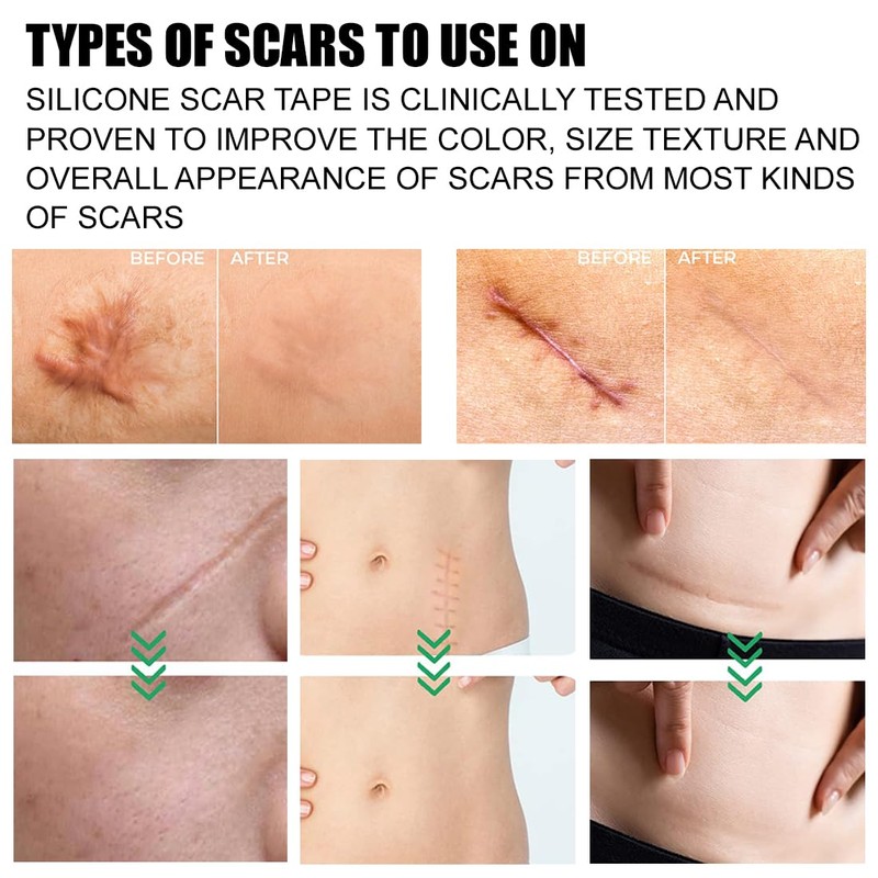 Silicone Scar Sheets 1.6" x 6" Silicone Scar Tape for