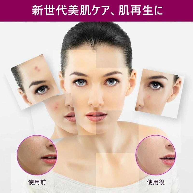 SrDiot ダーマローラー 1.0mm マイクロニードルローラー 美顔ローラー フェイスローラー 美肌 頭皮 シミ 薄毛