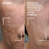 Advanced Microdermabrasion Face Exfoliator by Dr. Brandt for Unisex -