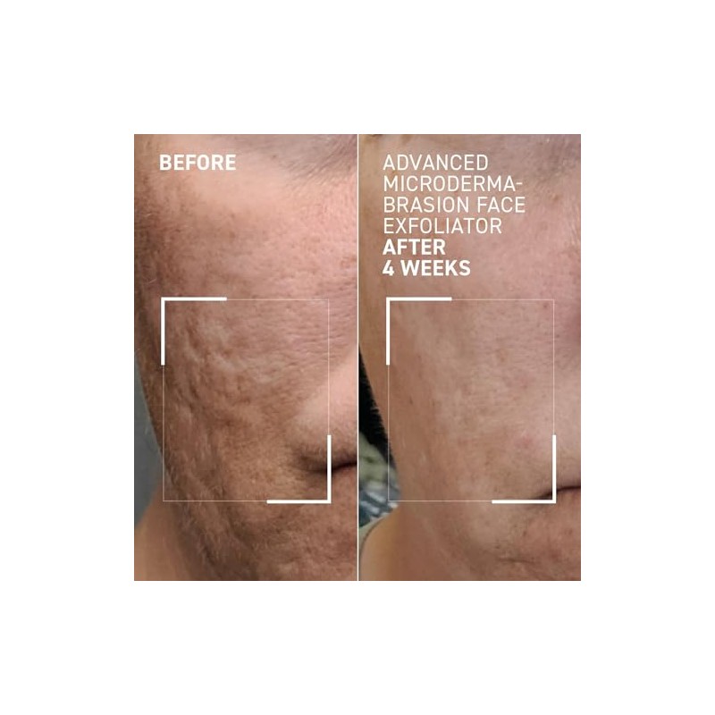 Advanced Microdermabrasion Face Exfoliator by Dr. Brandt for Unisex -