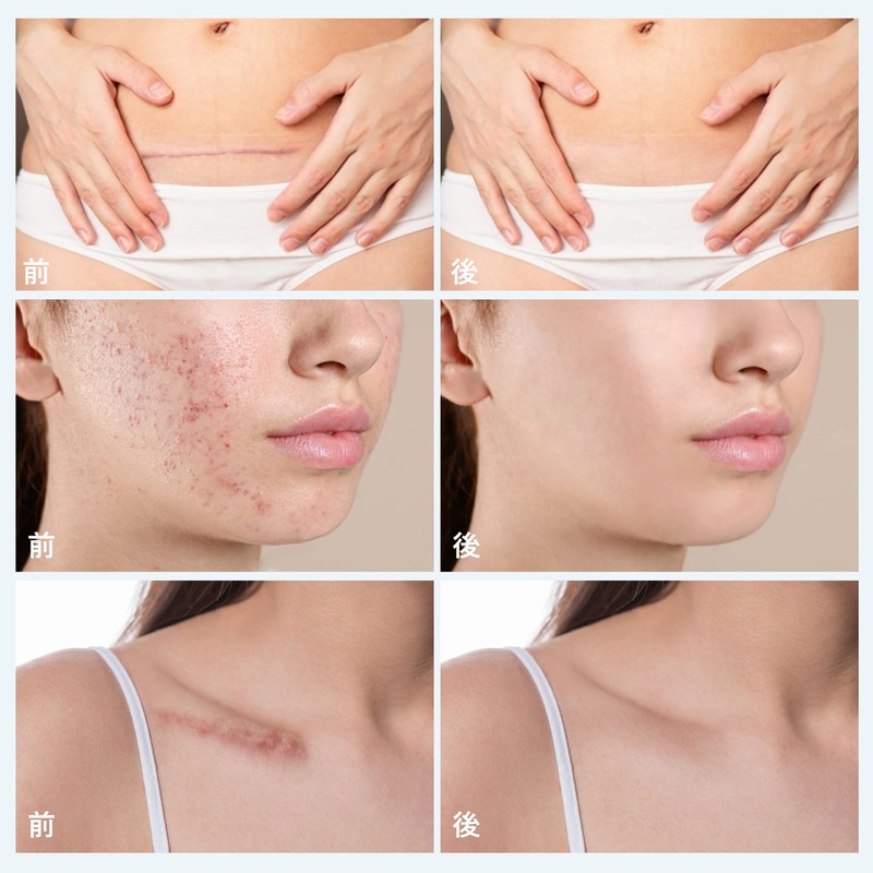 手術後 帝王切開 傷あ 米国式デザインテスト シリコーンゲルテープ ４センチ×150 センチ, ４センチ×300 センチ (４センチ×１５０センチ)