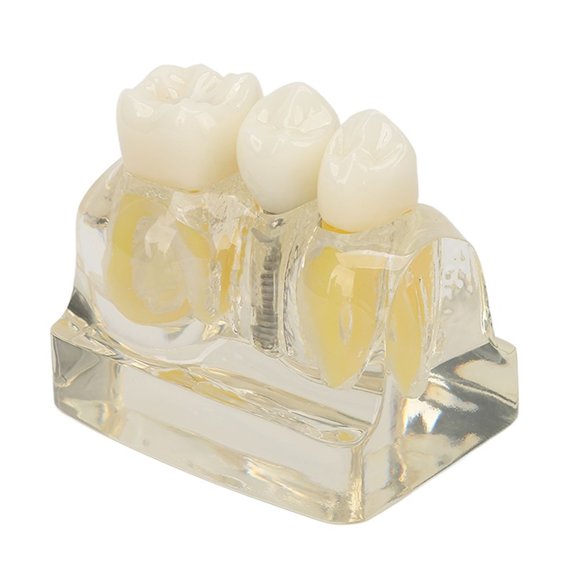 Teeth Implant Model Transparent Dental Teaching Research Demonstration Teeth Model